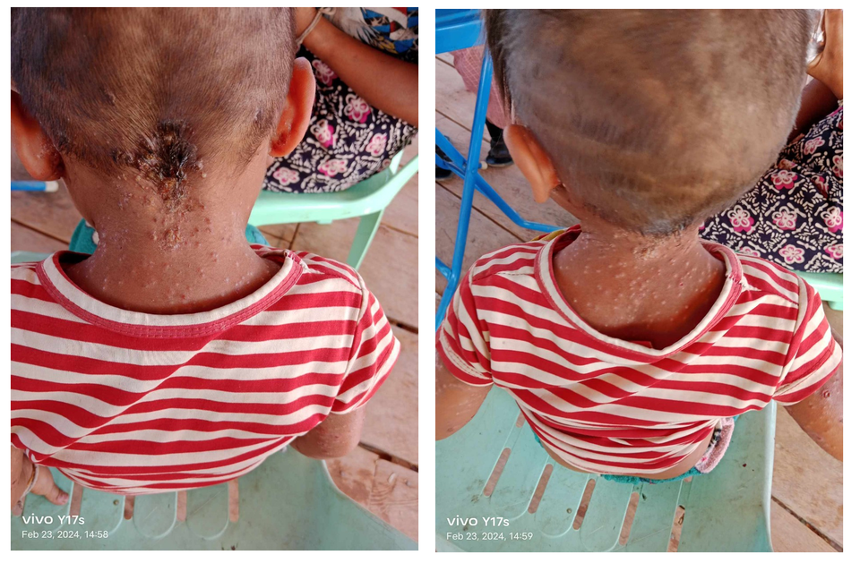 미얀마 산족 아이는 의료 기술을 배운 목회자의 치료로 증세가 확실히 호전되었다