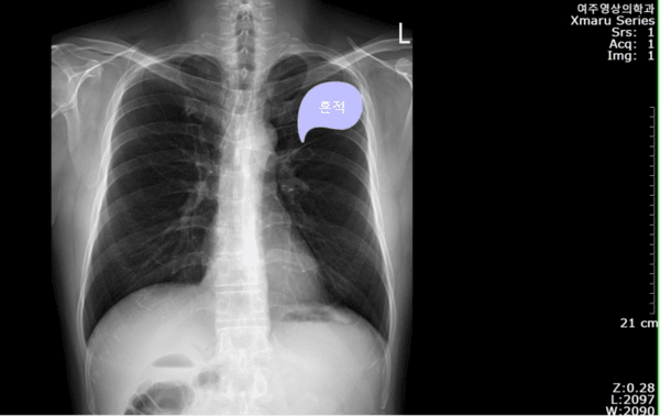 과거에 폐결핵을 앓은 흔적이 보입니다.