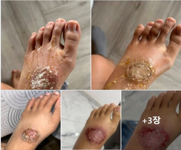 김소금 선교사는 최근 현지 질병인 악성 습진으로 인하여 급히 귀국, 현재 국내 의료진을 통해 치료 중이다.